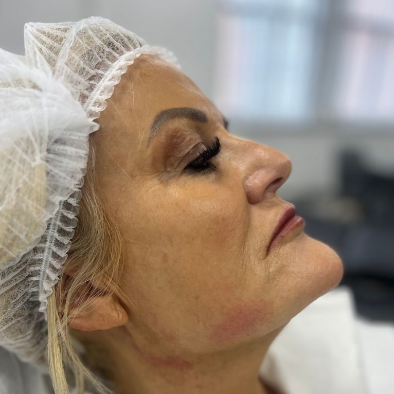 Advanced Dermal Filler (Chin/Cheek/Jaw/Tear Trough)