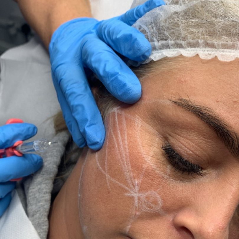 Basic Dermal Filler