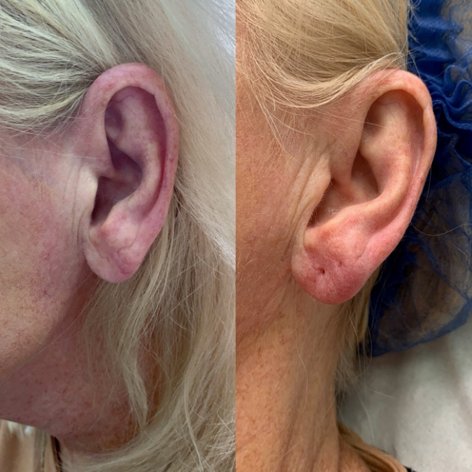 Earlobe Rejuvenation