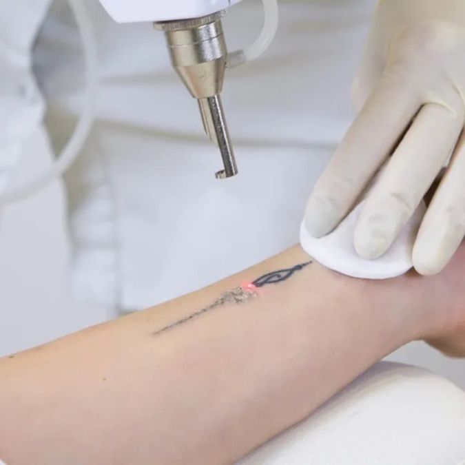 Level 5 Diploma In Tattoo Removal (RQF)